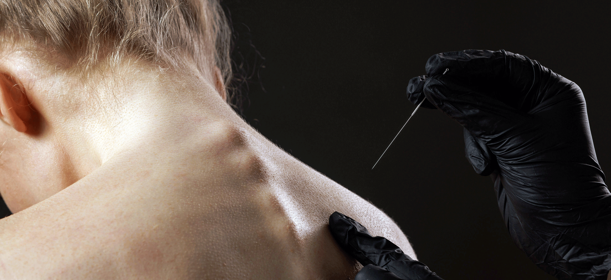 Dry Needling → depositphotos 796867158 xl